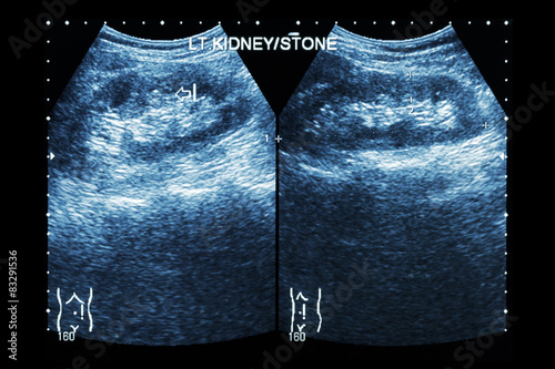 Ultrasonography of kidney : show left kidney stone  photo