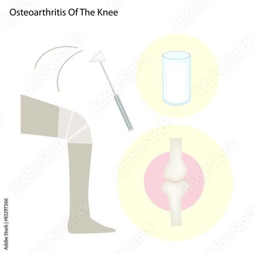 Illustration Set of Osteoarthritis of The Knee