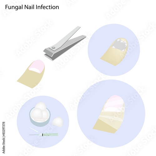 Fungal Nail Infection and Take Care