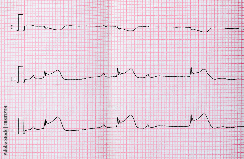 ECG with macrofocal myocardial infarction, AV block ECG with macrofocal myocardial infarction, AV block