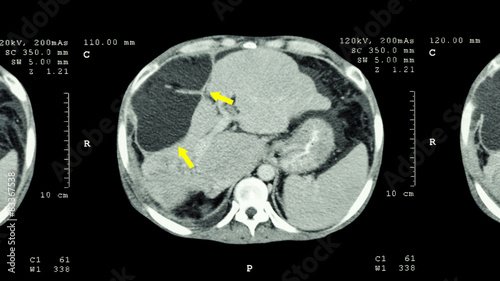 CT scan of upper abdomen : show mass at liver ( Liver cancer )