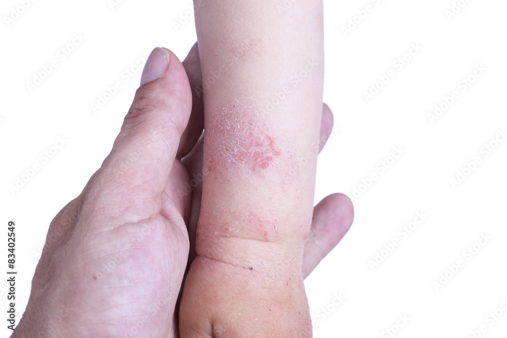 Eczema on the kid's hand Eczema on the kid's hand