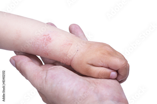 Eczema on the kid's hand
