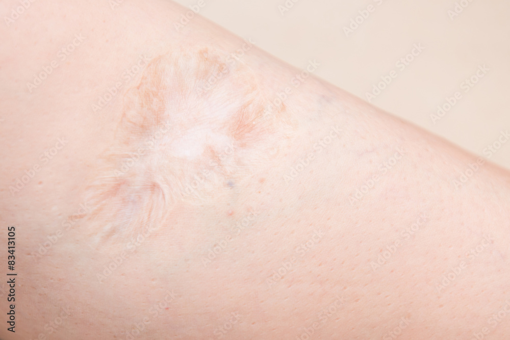 Fototapeta premium scars on leg wound from missile