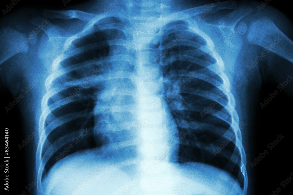 Pulmonary Tuberculosis ( Chest X-ray of child ) Pulmonary Tuberculosis ( Chest X-ray of child )