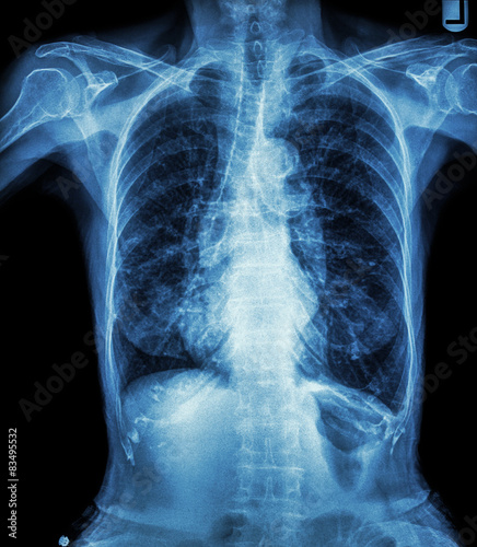 Chest X-ray of old patient ( calcification at rib , trachea ) photo
