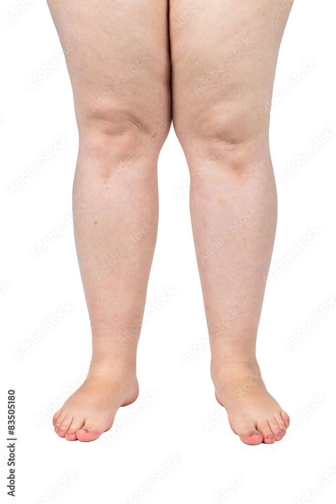 legs obese. Weight problems. trouble walking. płaskosotopie, valgus knee  Stock Photo | Adobe Stock