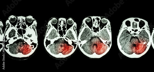 Canvas Print Stroke  ( CT scan of brain and base of skull and Stroke )