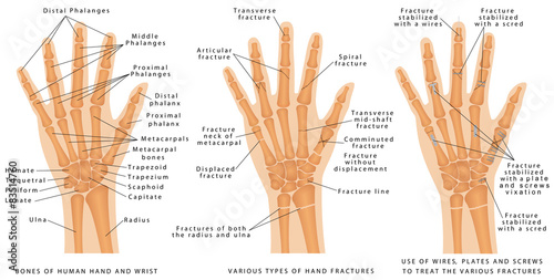 Various types of hand fractures