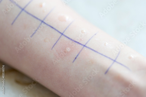 Close up of marking on allergic woman's hand photo