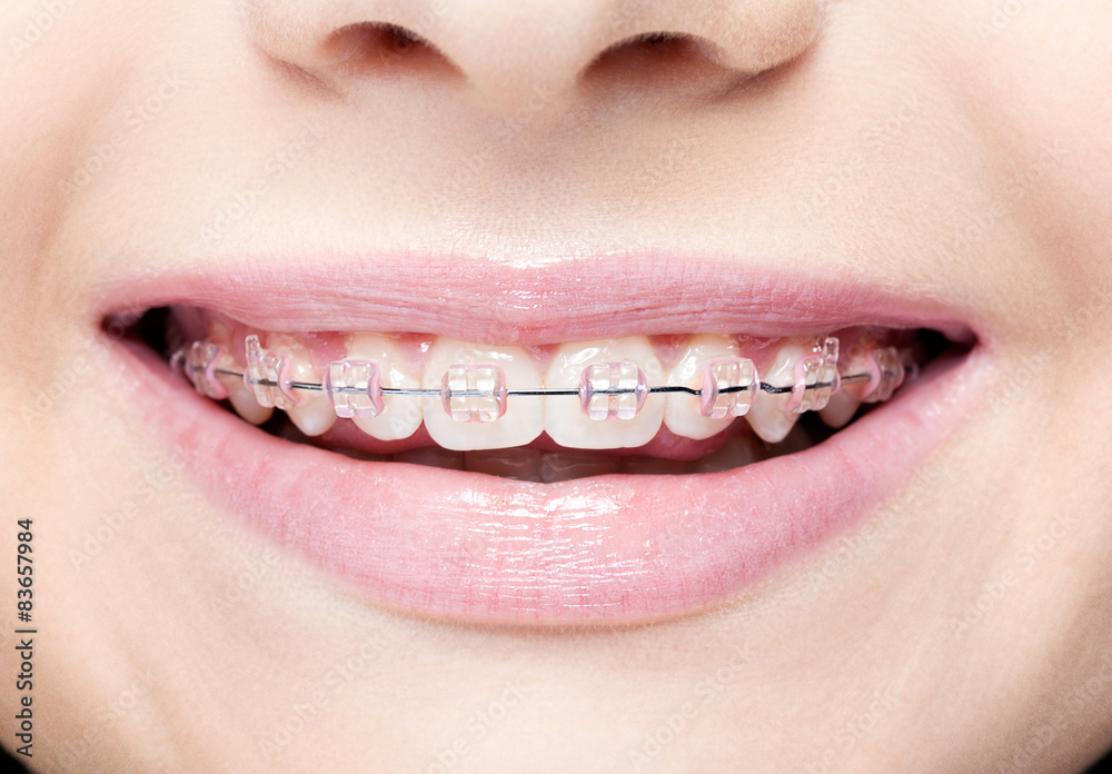 Fototapeta premium Closeup of female open mouth with pink lips and brackets