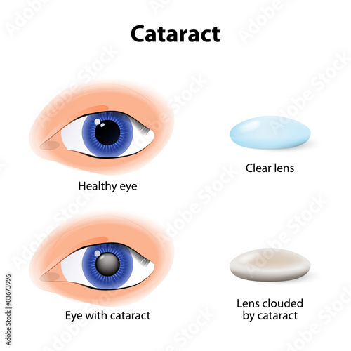 A cataract is an clouding crystalline lens