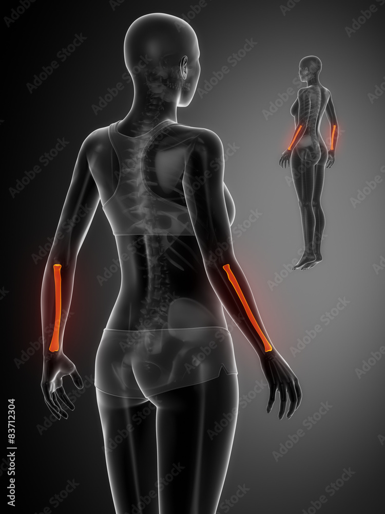 RADIUS black x--ray bone scan RADIUS black x--ray bone scan