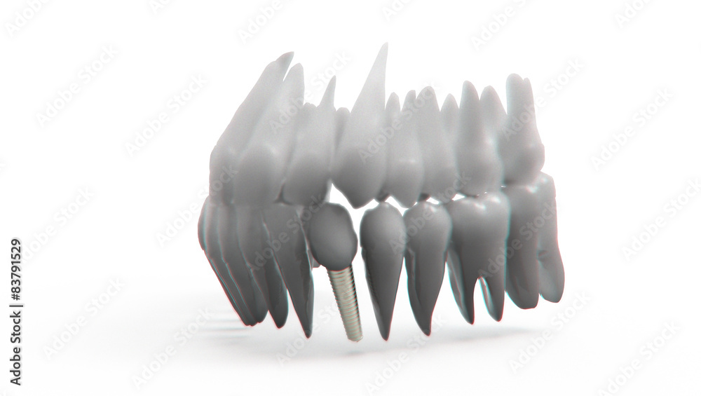 Dental implant