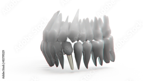 Obraz na płótnie Dental implant w salonie