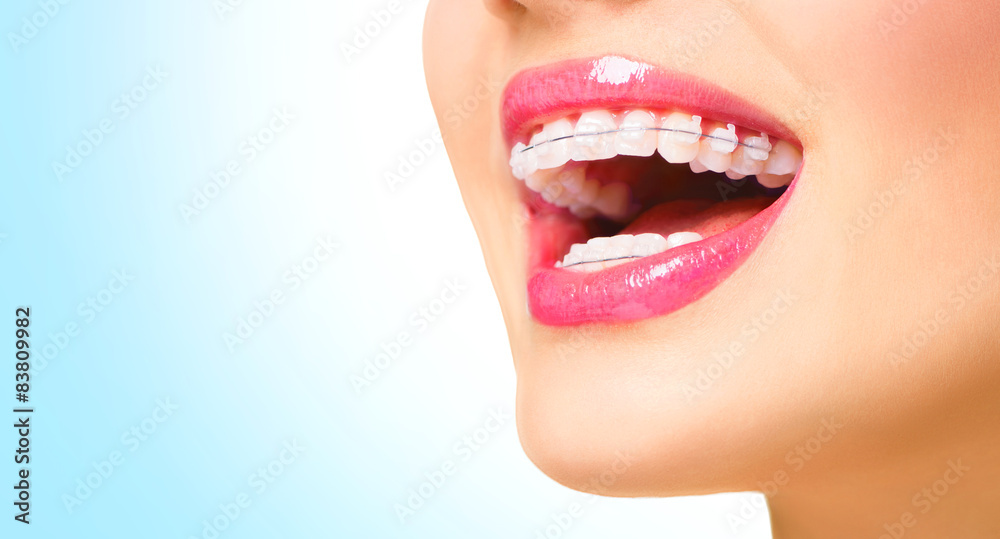 Obraz premium Beautiful woman smiling. Closeup ceramic braces on teeth