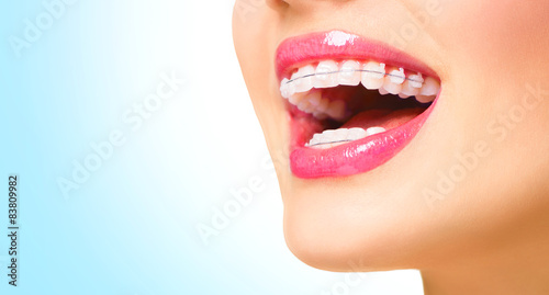 Beautiful woman smiling. Closeup ceramic braces on teeth