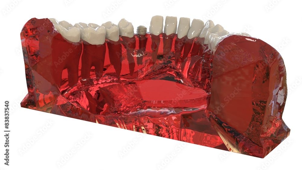 Dental Implant