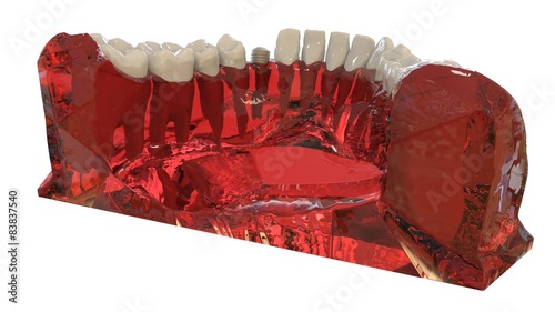 Obraz na płótnie Dental Implant w salonie