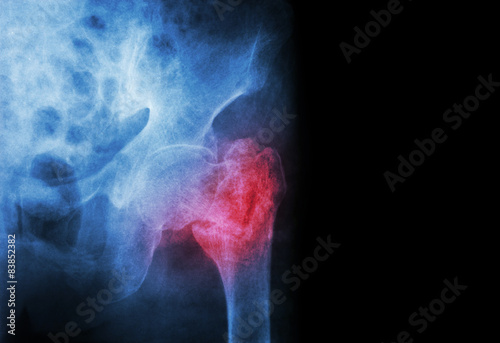intertrochanteric fracture left femur ( Thigh bone ) 