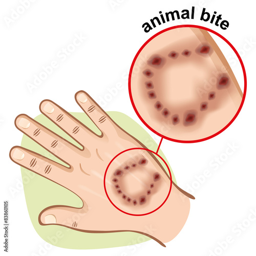 First aid, open hand with an animal bite