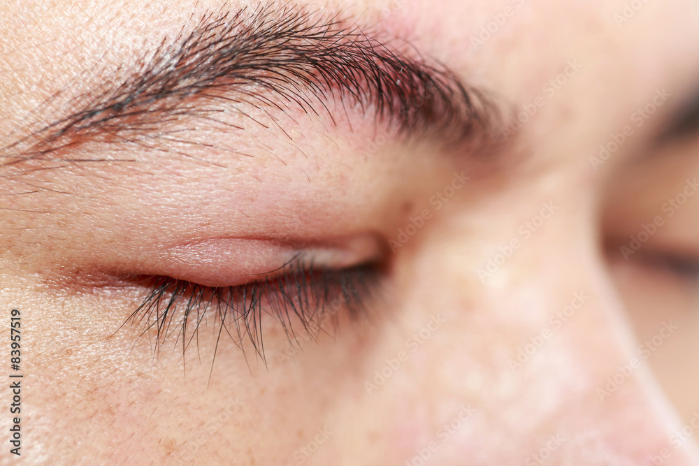 Fototapeta premium Right upper eye lid abscess 