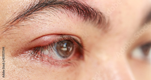 Tableau sur toile Right upper eye lid abscess stye or hordeolum