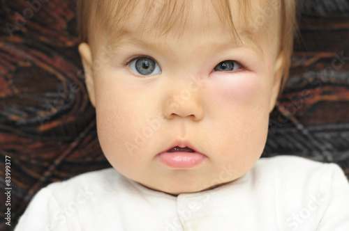 baby with a swollen eye from an insect bite