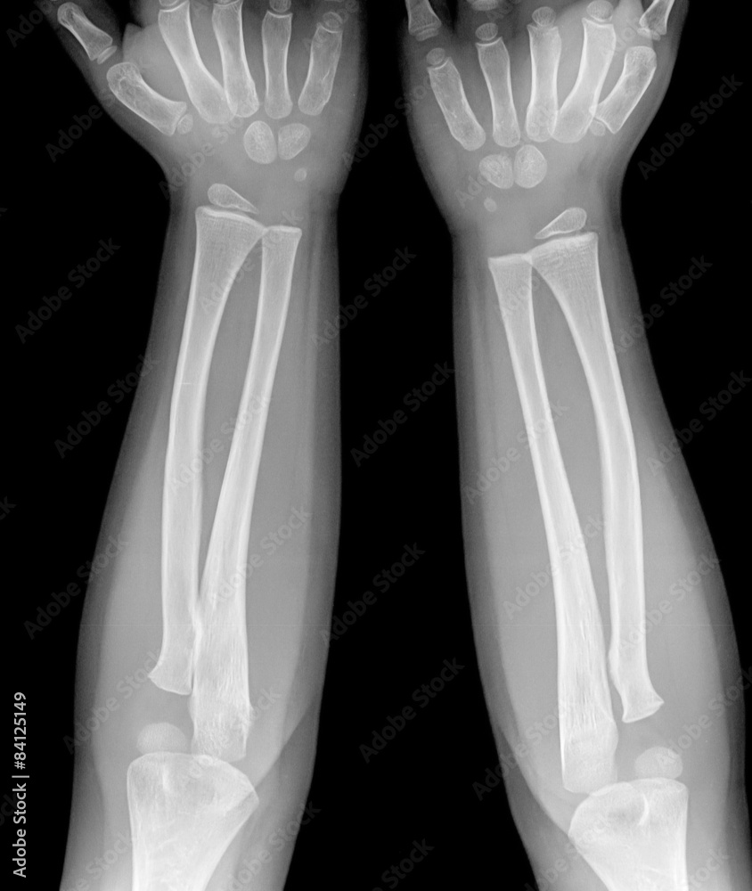 film xray forearm show normal infant's bone Stock Photo Adobe Stock