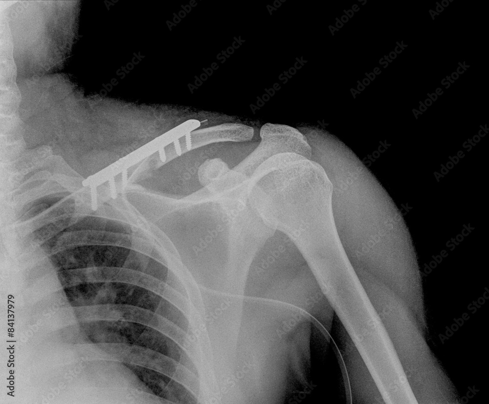 X Ray Of Collarbone Stock Photo Adobe Stock