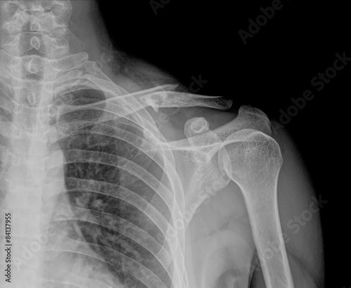 Obraz na płótnie X- ray of collarbone