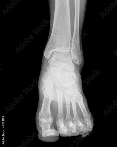Front view of foots on x-ray film