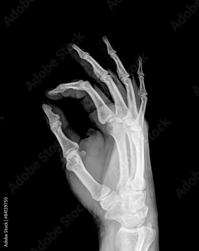 X-ray of both human hand (OK!)