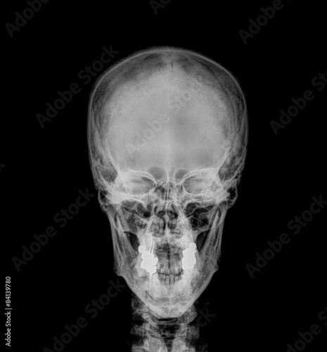 Film skull, antero-posterior view