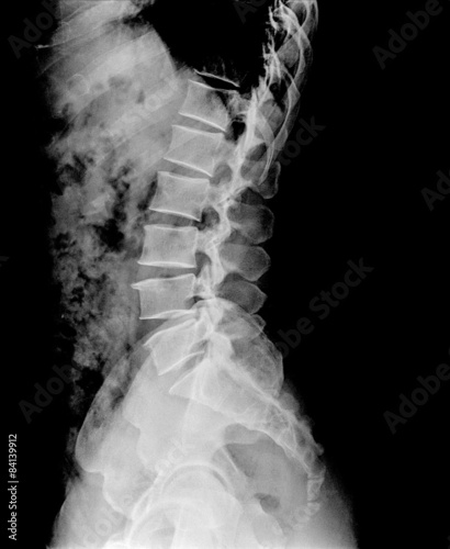 фотографія x ray of human lumbar spine lateral