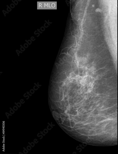 X-ray of Breast Cancer photo