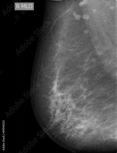 Mammography photo