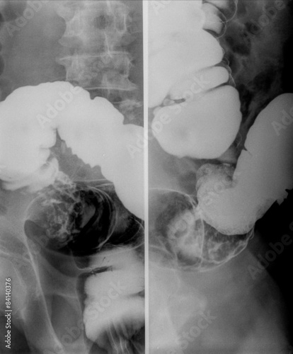 x ray Colon with barium,AP view , Pre evacuation