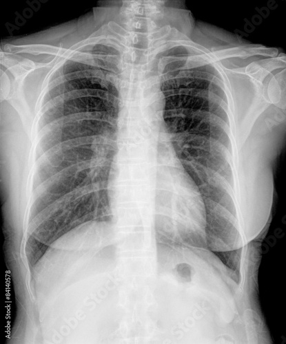 Detail of an x-ray of lungs