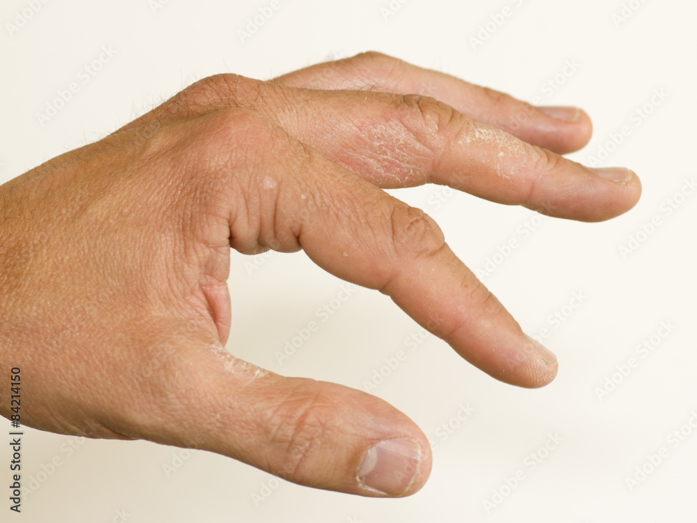Hand Neurodermitis 601 Hand Neurodermitis 601