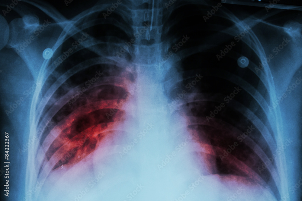 Pulmonary Tuberculosis ( TB ) : Chest x-ray show alveolar infiltration at both lung due to mycobacterium tuberculosis infection Pulmonary Tuberculosis ( TB ) : Chest x-ray show alveolar infiltration at both lung due to mycobacterium tuberculosis infection