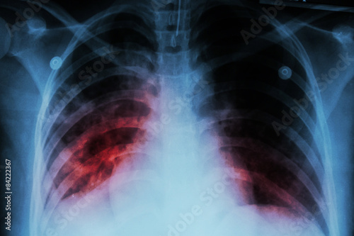 Pulmonary Tuberculosis ( TB )  :  Chest x-ray show alveolar infiltration at both lung due to mycobacterium tuberculosis infection photo