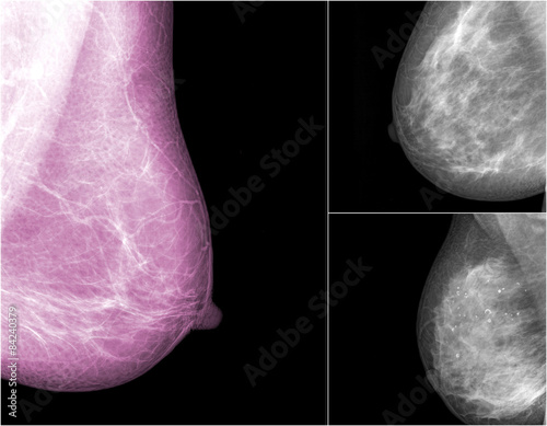 Картината върху платно collection of Mammogram radio imaging for breast cancer