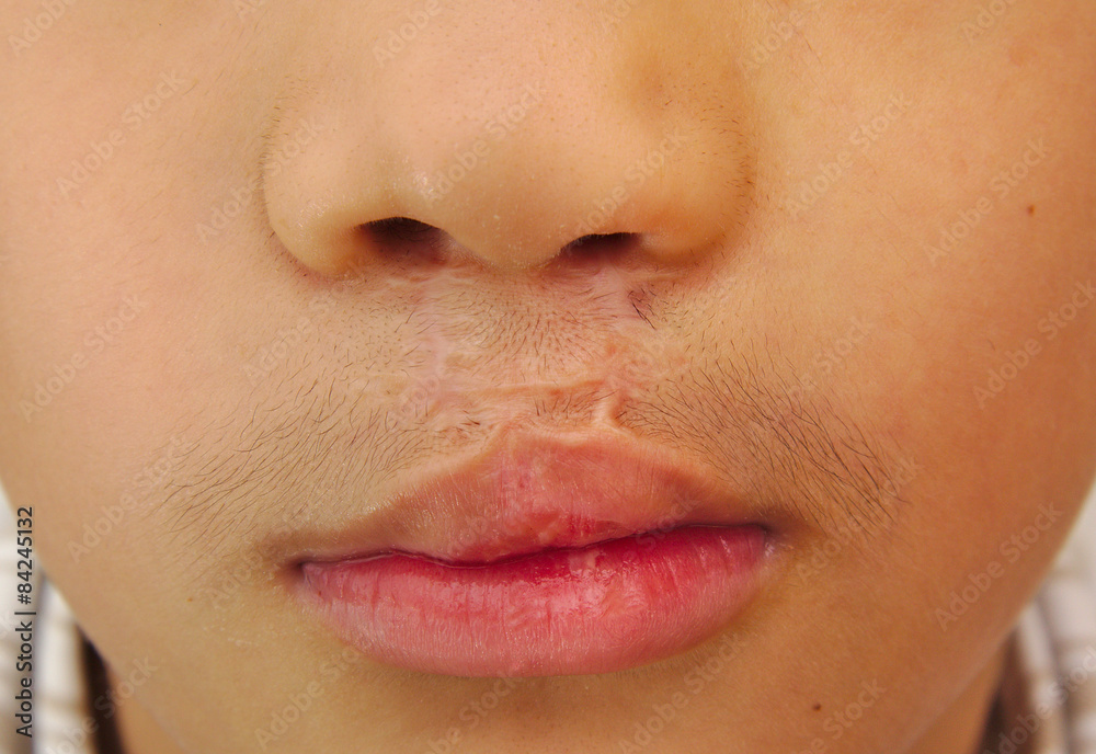 Boy showing a bilateral cleft lip repaired. Boy showing a bilateral cleft lip repaired.