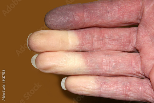Fingers with Reynauds