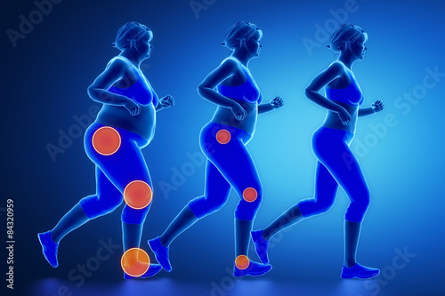 Obesity joint problem concept