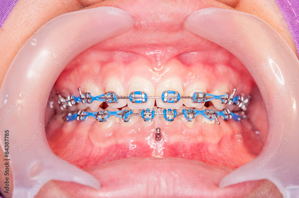 Close-up Orthodontic braces with o-ring