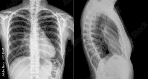 Tableau sur toile Film chest x-ray PA upright : show 2 different view
