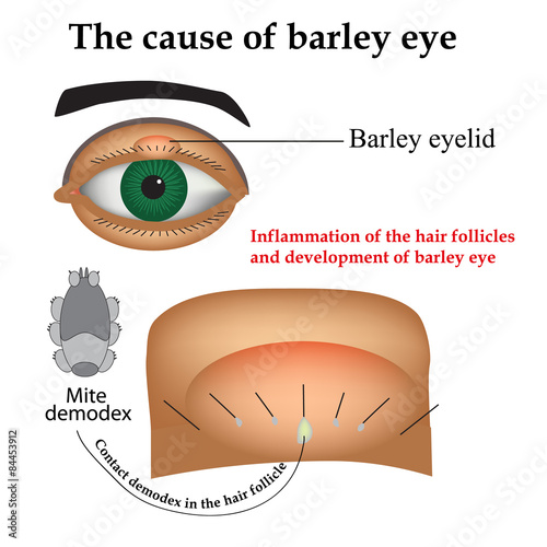 Diseases of the eye barley. Causes of barley. Demodex mite