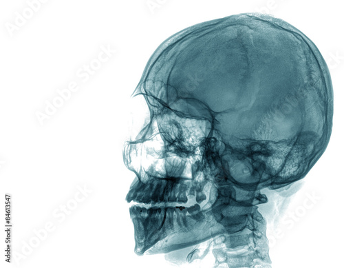 X-ray of a human skull photo